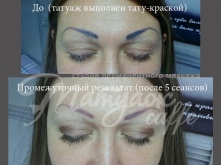 Лазерное удаление татуажа
